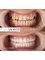 BeWell Health Assistance Dental - Zirconium crown treatment that we applied to our patient. Perfect appearance and happy patient. 