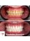BeWell Health Assistance Dental - Monolothic Zirconium treatment we applied to our patient. Perfect appearance and happy patient. 