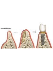 Bone Graft  - Bianco Dental