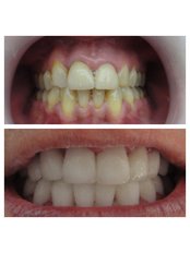 Zirconia Crown - Bianco Dental