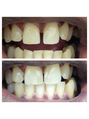 Dental Bonding - Bianco Dental