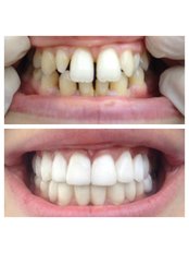 Veneers - Bianco Dental