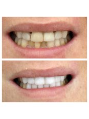 Dental Crowns - Bianco Dental
