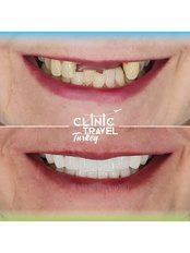 Dental Implants - CLINIC TRAVEL TURKEY - IZMIR