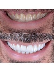 Zirconia Crown - Dent Leon Dental Clinics