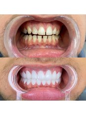 E-Max Porcelain Veneers - Dent Leon Dental Clinics