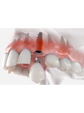 Single Implant - Dent Leon Dental Clinics