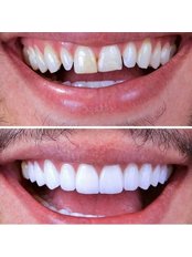 Zirconia Crown - Dent Leon Dental Clinics