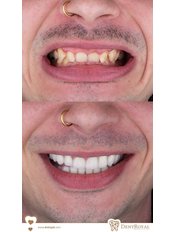 Hollywood Smile Packet - 28 ZİRCONİUM CROWN (1 hour, 3 sessions) - Dent Royal Dental Clinic