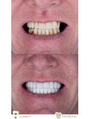 All-on-6 Dental Implants-ICX (PREMİUM ZİRCON) (2 hours, 2 sessions) - Dent Royal Dental Clinic