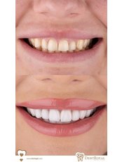 LAMİNATE VENEER - Dent Royal Dental Clinic