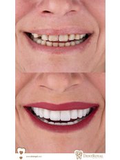 SMİLE DESIGN PACKET (1 hour, 3 sessions) - Dent Royal Dental Clinic