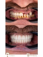 All-on-4 Dental Implants Straumann (2 hours, 2 sessions) - Dent Royal Dental Clinic