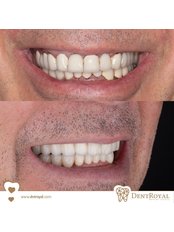Dental crown - Dent Royal Dental Clinic