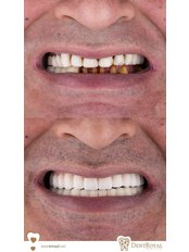 All-on-4 Dental Implants ( ICX ) (2 hours, 2 sessions) - Dent Royal Dental Clinic