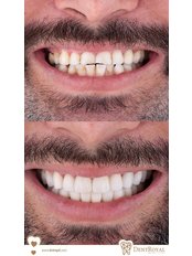Zirconia Crown - Dent Royal Dental Clinic