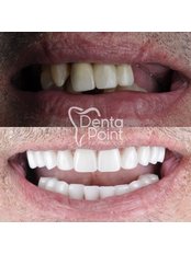 Dental Implants - DentaPoint | Dental Hospital
