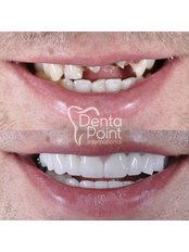 Dental Bridges - DentaPoint | Dental Hospital