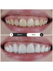 Veneers - DentaPoint | Dental Hospital