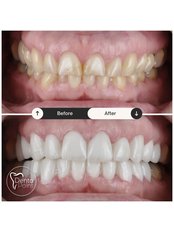 Porcelain Crown - DentaPoint | Dental Hospital