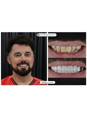 Dental Crowns - DentaPoint | Dental Hospital
