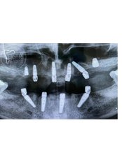 Bone Graft - DentaPoint | Dental Hospital