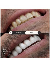 Zirconia Crown - DentaPoint | Dental Hospital