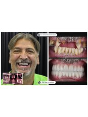 All-on-6 Dental Implants - DentaPoint | Dental Hospital