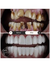 All-on-4 Dental Implants - DentaPoint | Dental Hospital