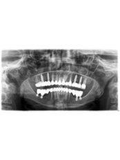 Sinus Lift - DentaPoint | Dental Hospital
