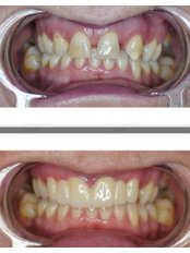 Smile Makeover - Dt. Sevtap Gurgan Dental Clinic