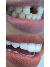 Hollywood Smile - FineClinics