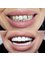 Hildent - smile correction with veneers 