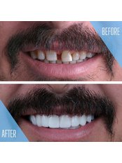 Smile Makeover - Hollywood Dental