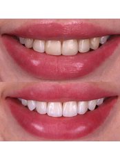 Dental Implants - Locadent