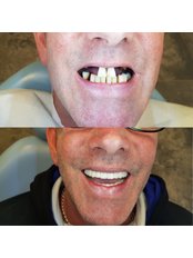 All-on-6 Dental Implants - Med Smyrna
