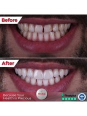 Zirconia Crown - Mita Dental Clinics