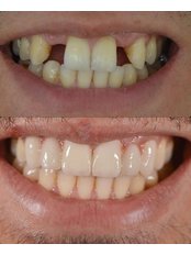 Dental Implants - My Nova Dental Clinic- Izmir