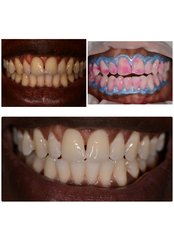 Regular Teeth Cleaning - My Nova Dental Clinic- Izmir