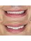 Pros Esthetic Dental Clinic - Before-After 3 