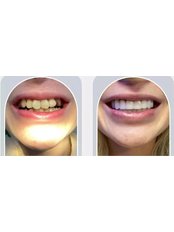 Teeth Whitening - Qairydent