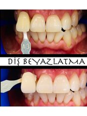 Teeth Whitening - Qklinik
