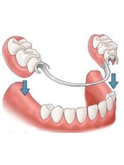 Dentures - Tooth & Implant Dental Clinic