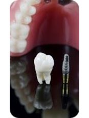 Dental Implants - Tooth & Implant Dental Clinic
