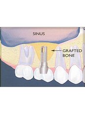 Sinus Lift - Tooth & Implant Dental Clinic