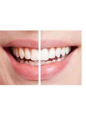 Teeth Whitening - Tooth & Implant Dental Clinic