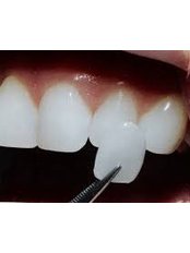 Veneers - Tooth & Implant Dental Clinic