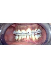 Braces - Tooth & Implant Dental Clinic