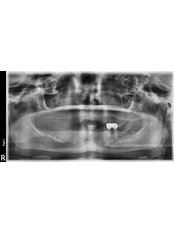 Dental X-Ray - Tooth & Implant Dental Clinic