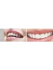 Cosmetic Dentist Consultation - Tooth & Implant Dental Clinic